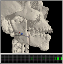 video
of craniofacial surgical simulation